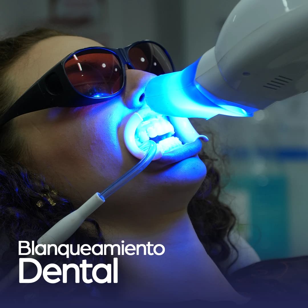 Procedimiento de blanqueamiento dental profesional