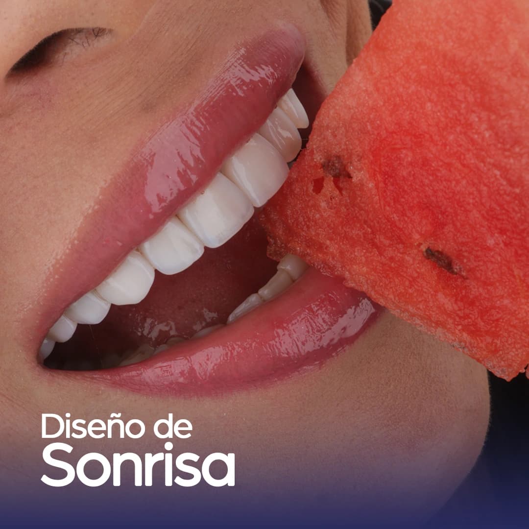 Diseño de Sonrisa