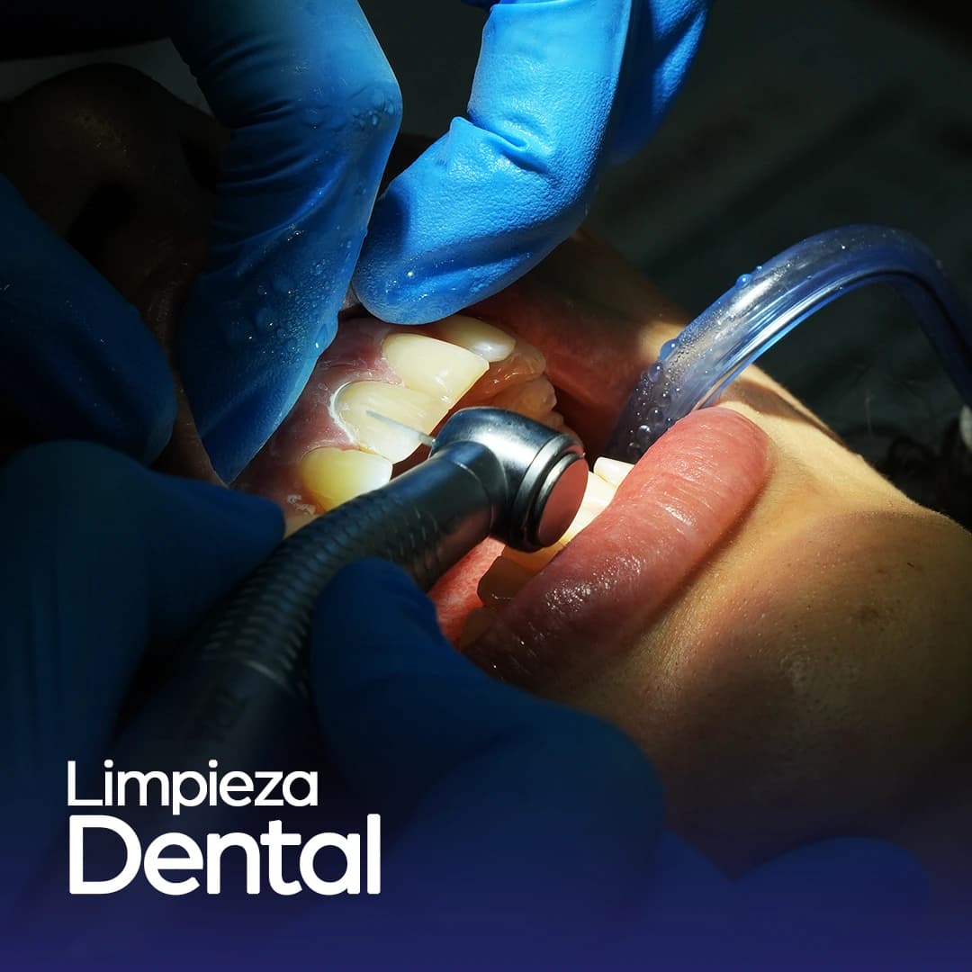 Procedimiento profesional de limpieza dental