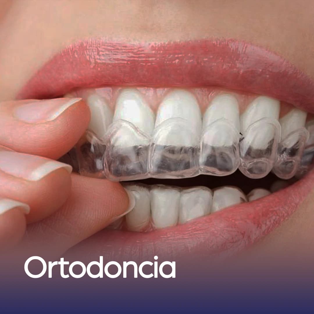 Tratamiento de ortodoncia con alineadores transparentes